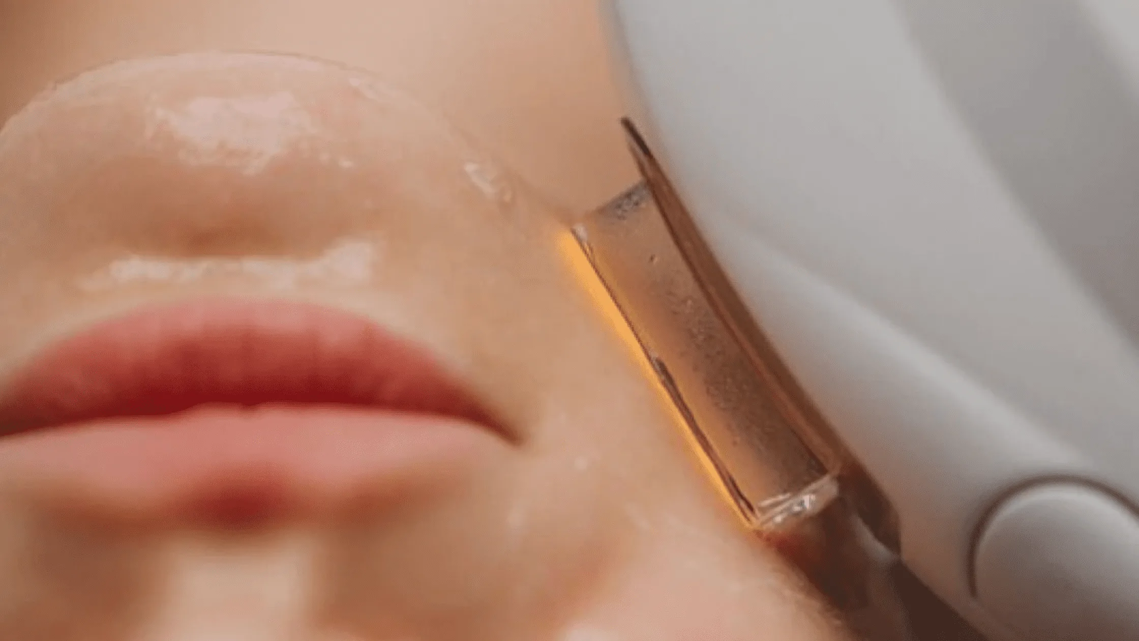 IPL laser treatment banner image