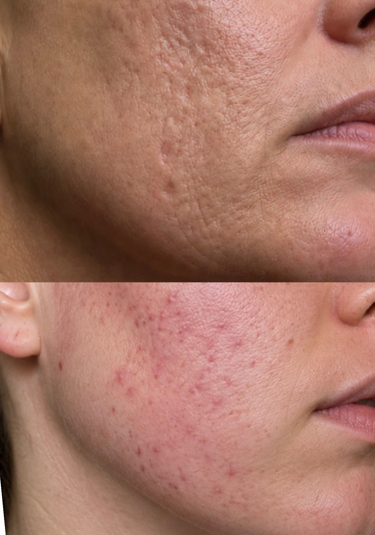 Close up of acne scarring on the cheek and jawline showing textural change and post inflammatory redness
