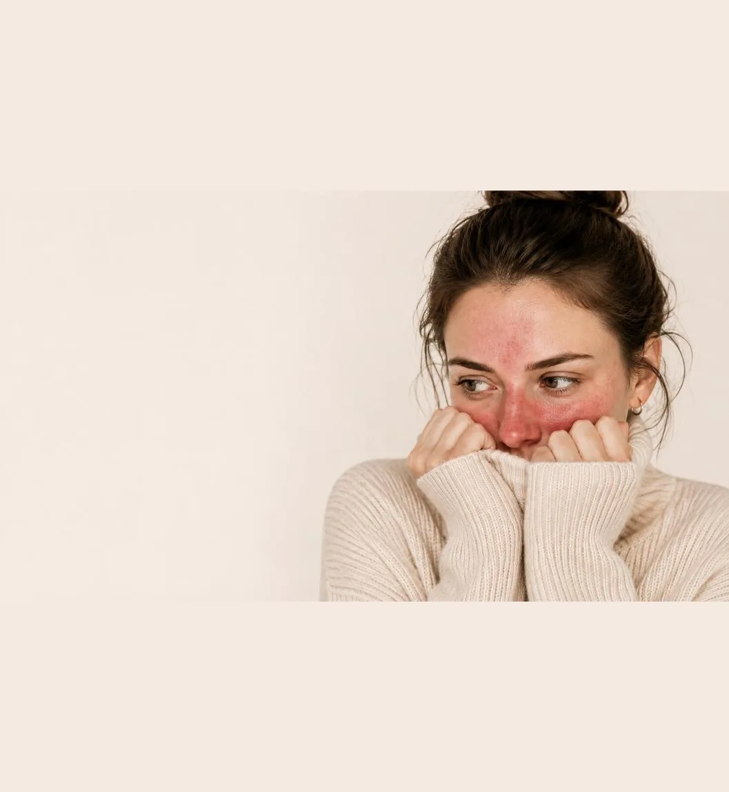 Woman with rosacea showing redness across her forehead, nose and cheeks